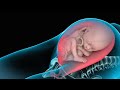 3D Medical Animation Cesarean Birth (C-section)