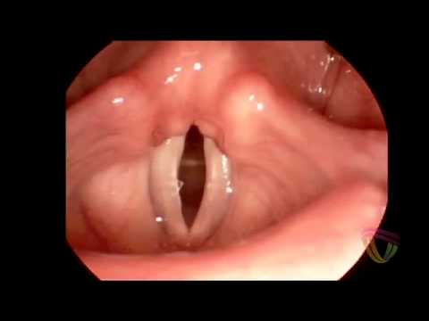 Speech-Language Pathology: The Vocal Cords in Action - YouTube
