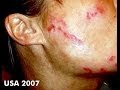 MORGELLONS :enfer nanotechnologique et chemtrails