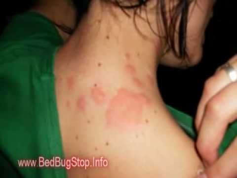 Bed Bug Bites New York - YouTube
