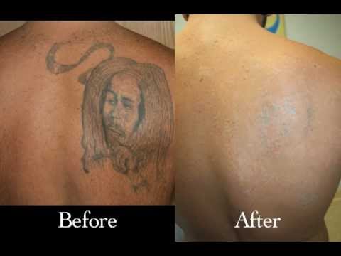 Before and After Tattoo Removal - YouTube