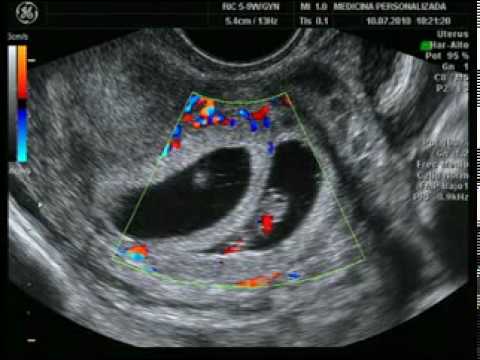 Ecografia de mellizos de 8 semanas - Imagui