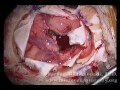 Brain surgery removal of metastatic tumor high power surgical microscope