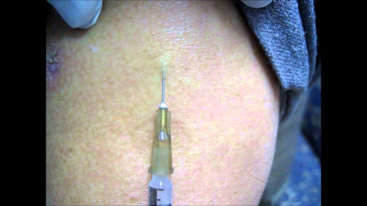 How To Give Intradermal Injection? - YouTube