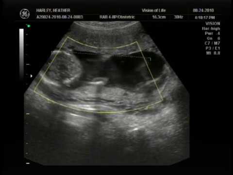 3D/4D Ultrasound at 15 weeks Video!! - YouTube
