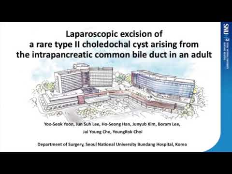 Laparoscopic Excision of a Rare Type II Choledochal Cyst Arising from the Intrapancreatic Common Bile Duct in an Adult