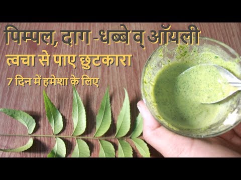 Pimple, Daag- Dhabbe व Oily Skin से पाए छुटकारा पाए हमेशा के लिए- How To Remove Pimple, Pimple Marks