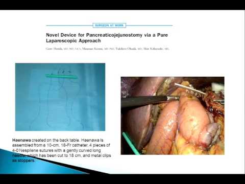 Various Pancreatic Anastomosis - Laparoscopic Pancreaticojejunostomy 