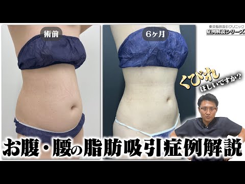 脂肪吸引でくびれを創りたいなら・・・【お腹・腰の脂肪吸引症例解説】
