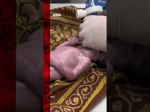 Baby saved from dead mother's womb after Israeli strike. #Shorts #Gaza #BBCNews