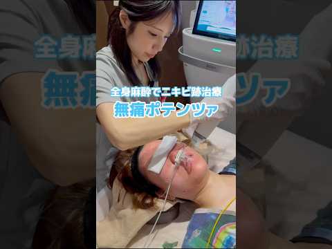 当院の無痛ポテンツァ🫧 #ポテンツァ#ニキビ跡 #クレーター #肌質改善 #毛穴 #全身麻酔 #shorts