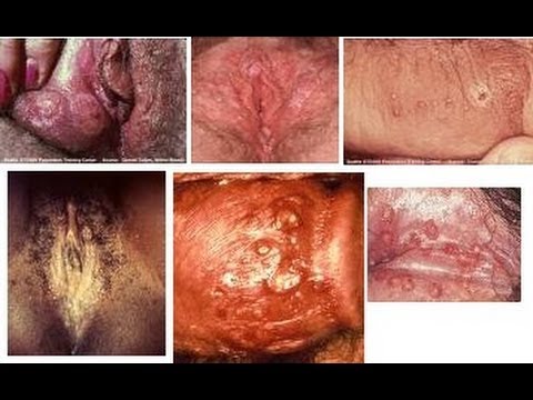 Herpes Simplex 2 Pictures : Herpes Simplex Type 1 and Type 2