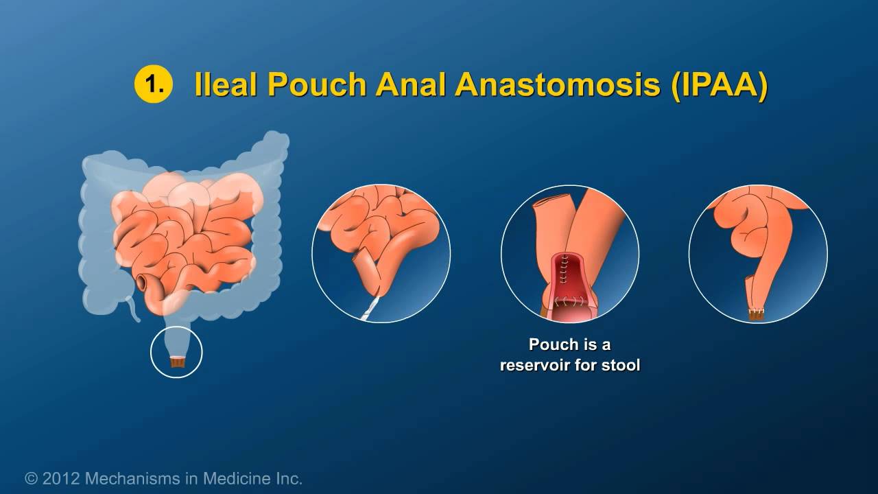 Small Bowel and Large Bowel Surgery - YouTube diagram of crohns disease 