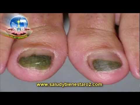 El mejor medio del hongo en la pared