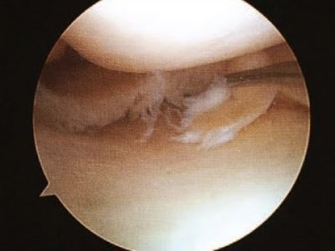 Meniscal Injury and Surgical Treatment: Meniscectomy and Meniscus Repair