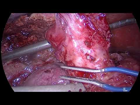 Laparoscopic Resection of an Intrapancreatic Granular Cell Tumor of the Biliary Tract