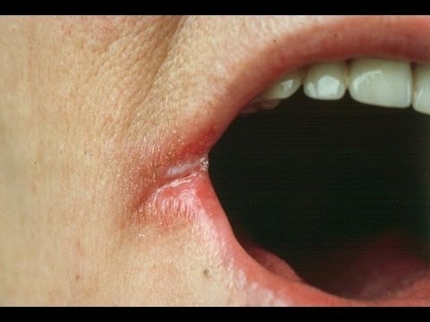 Dark Spot On My Lip - Doctor insights on HealthTap