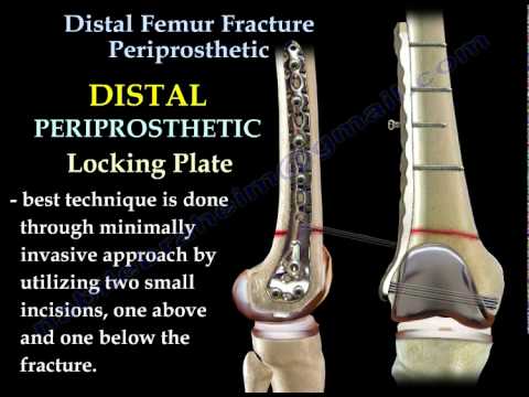Distal Femur Fracture Periprosthetic - Everything You Need To Know - Dr. Nabil Ebraheim - YouTube