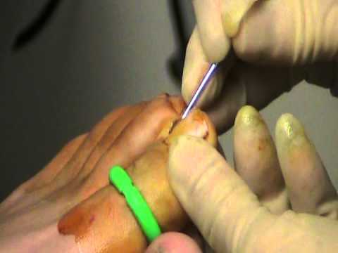 Phenol Matrixectomy, Partial Toe Nail Removal - YouTube