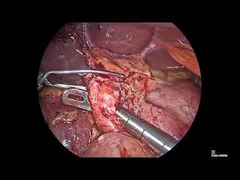 Laparoscopic Resection of Intrapancreatic Type2 Choledochal Cyst with Roux-en-Y Choledochojeejunostomy