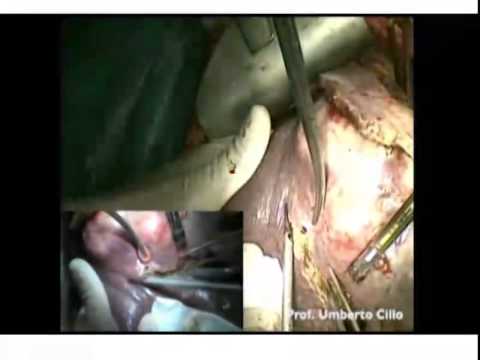Ex-situ (in vivo / ex-vivo) Liver Resection 