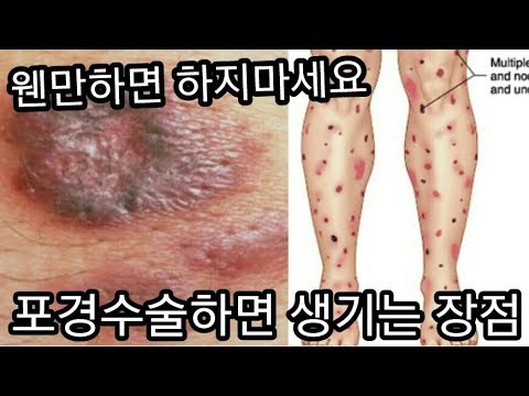 포경수술을 하면 생기는 장점 TOP3
