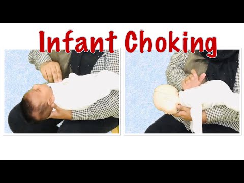 Infant choking | First aid for infant choking | Baby Choking