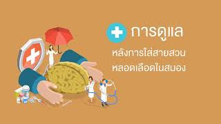 Acute stroke treatment before brain cell's death