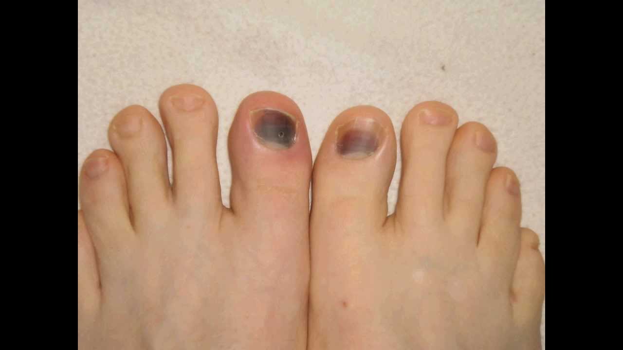 growths under toenails