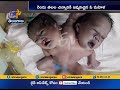 Woman Gives Birth To Baby With Two Heads, Three Hands
