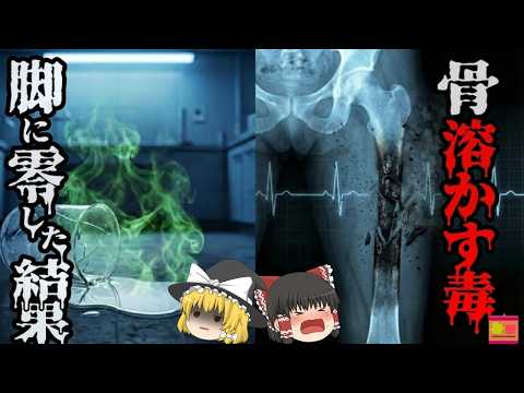 【1994】『硫酸より怖い液体』を足に零してしまった研究者の体内で一体何が起きていたのか？歴史の中で最も教訓的かつ恐ろしい『フッ化水素酸飛散事故』を解説