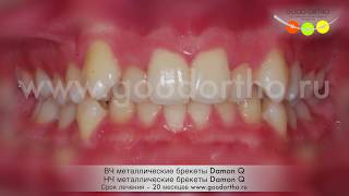 Выравнивание зубов с помощью металлических брекетов Damon Q.