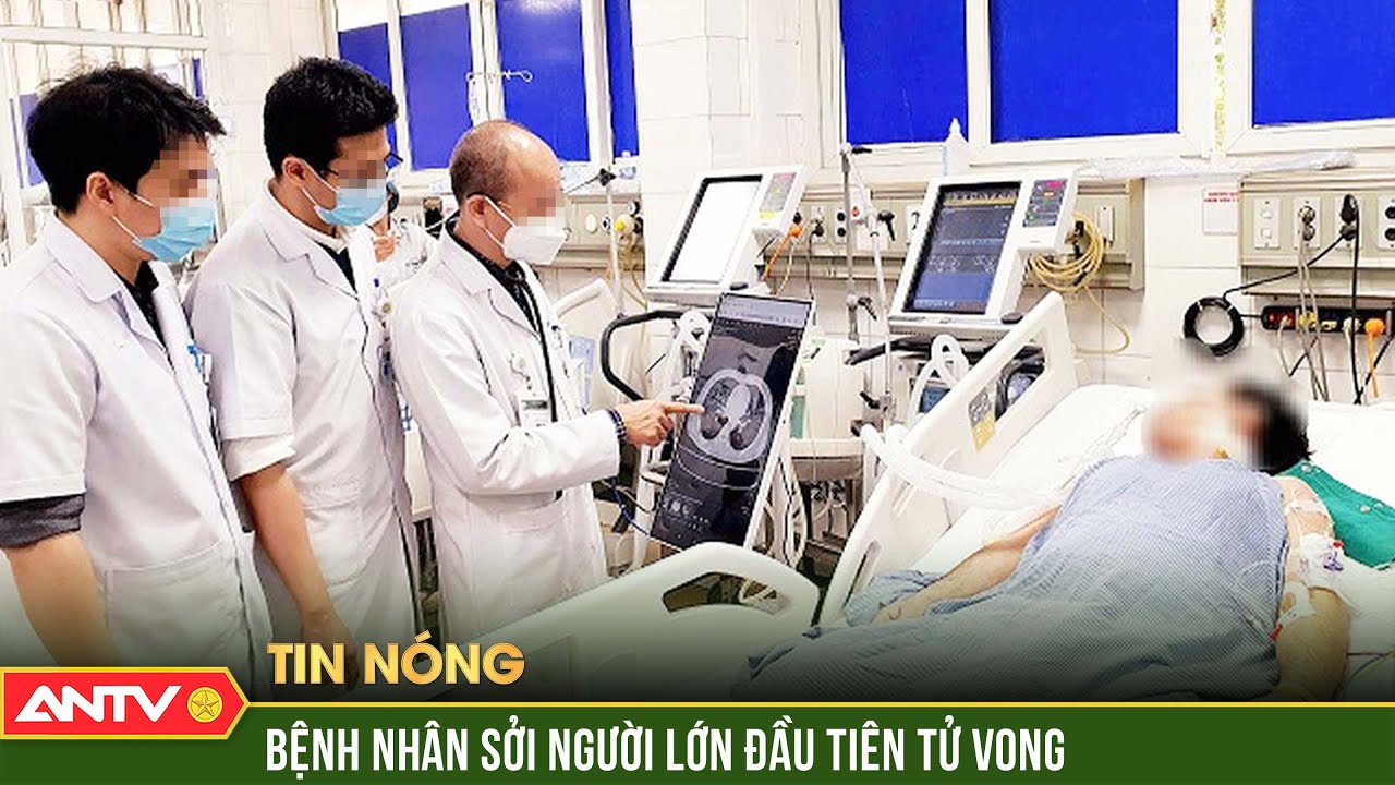 Ghi nhận ca tử vong do bệnh sởi ở người lớn đầu tiên trong năm 2025 | ANTV
