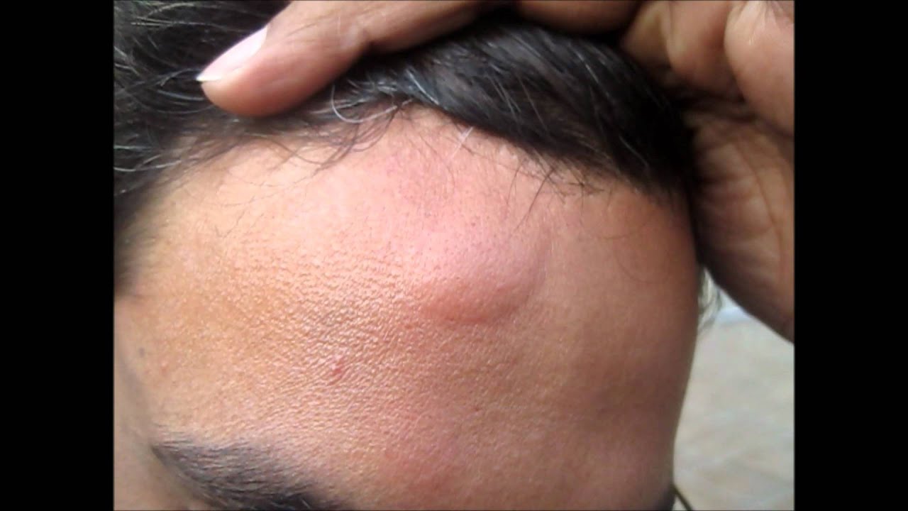 Head Injury Bump Home Treatment YouTube