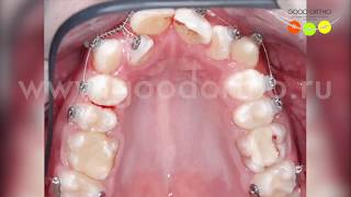 Как закрыть промежутки после удаления больных зубов своими здоровыми зубами?