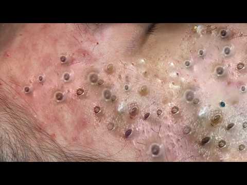 𝑪𝒚𝒔𝒕𝒊𝒄 𝑨𝒄𝒏𝒆 𝑹𝒆𝒎𝒐𝒗𝒂𝒍 & 𝑰𝒏𝒇𝒍𝒂𝒎𝒎𝒂𝒕𝒐𝒓𝒚 𝑨𝒄𝒏𝒆 #𝟖𝟔𝟖𝟔𝟕𝟔