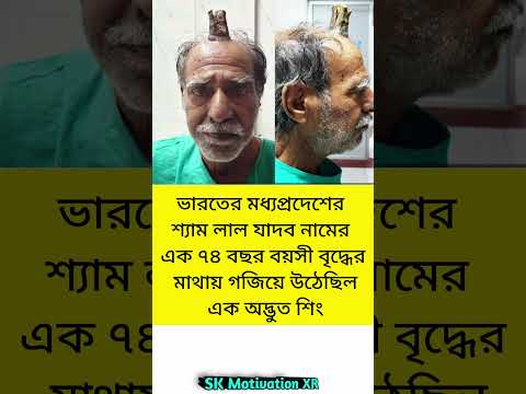 ভারতের মধ্যপ্রদেশের শ্যাম লাল যাদব নামের এক ৭৪ বছর বয়সী বৃদ্ধের মাথায় গজিয়ে উঠেছিল এক অদ্ভুত শিং