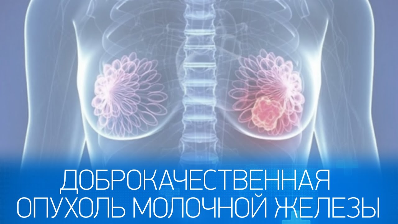 Доброкачественная опухоль молочной железы. Опухоли молочных желез. Доброкачественная опухоль груди. Новообразование молочной железы. Доброкачественная опухоль грудной железы.