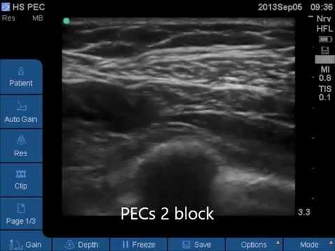 Lsora Us Guided Pecs Ii 2 Block