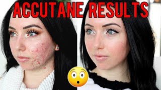 Accutane buy uk