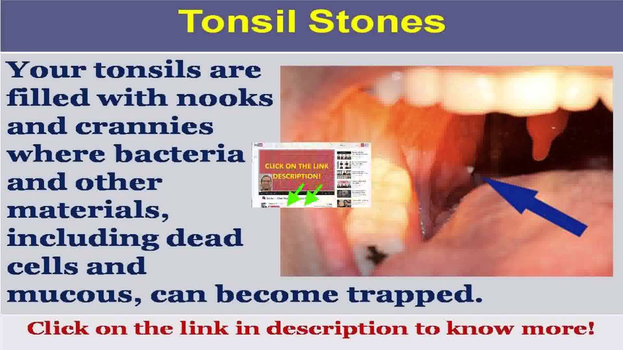 see-now-causes-of-tonsil-stones-youtube