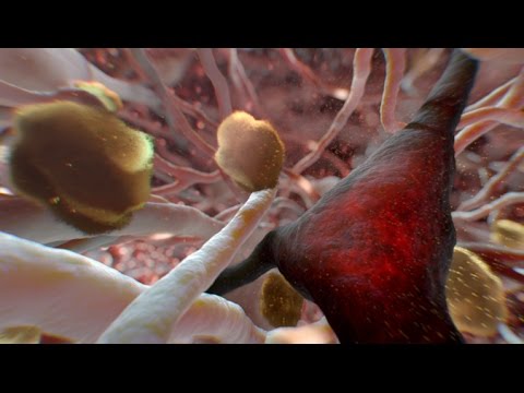 Can Alzheimer’s Be Stopped?'
