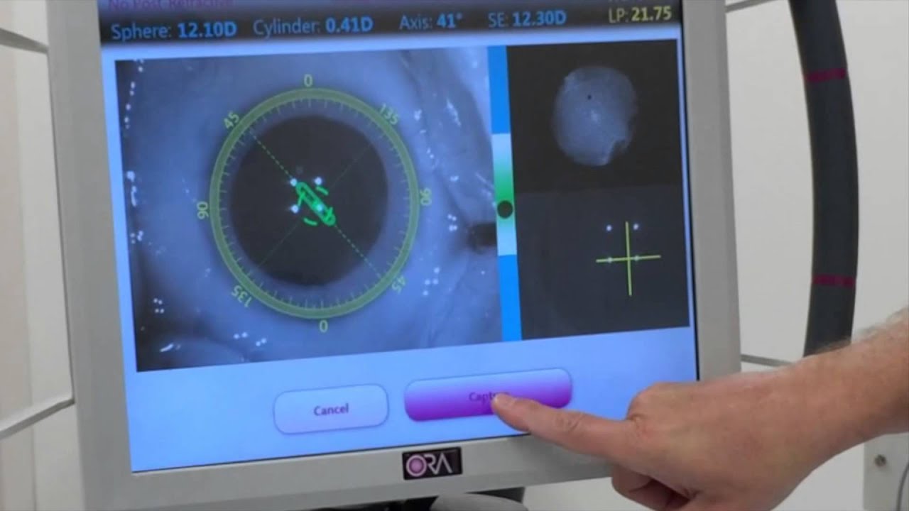 ORA Verifeye used in laser cataract surgery with the crystalens ...