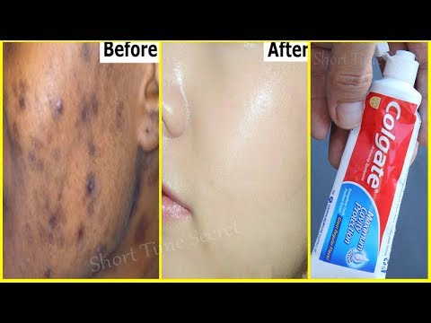 In 2 DAYS-Remove DARK SPOTS With Toothpaste |Apply Toothpaste on Your Darkspots and See the Magic