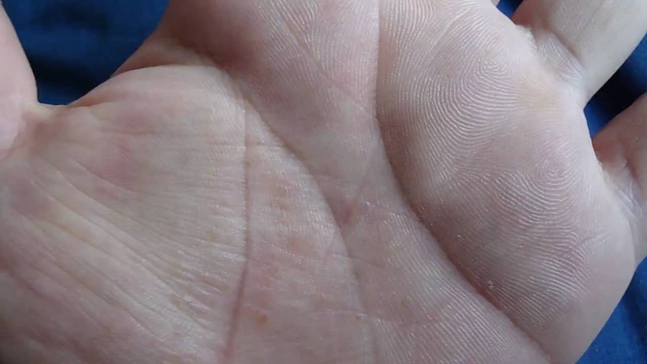 red spots on hand and feet