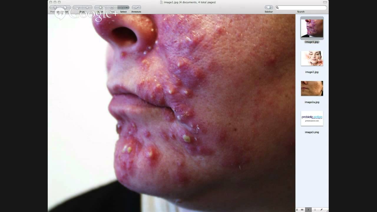 Natural Ways To Get Rid Of Acne While Pregnant Natural Ways To Get Rid Of Acne While Pregnant