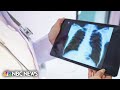 New lung cancer screening guidelines make millions more eligible for testing