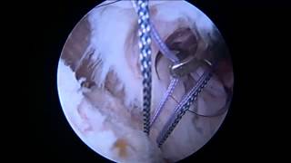 View video of Arthroscopic Rotator Cuff Repair