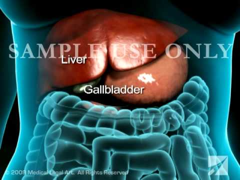 Condensed Cholecystectomy (Gallbladder Removal Surgery) - YouTube