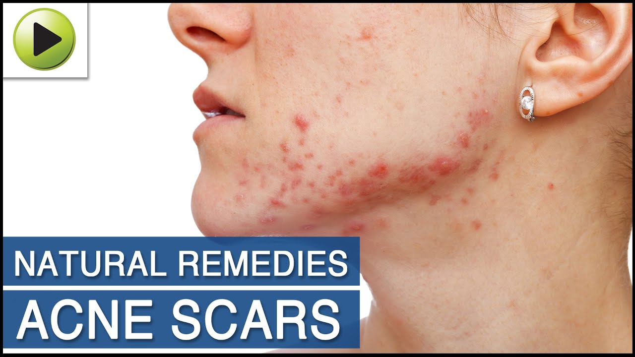 Skin Care - Acne Scars - Natural Ayurvedic Home Remedies - YouTube